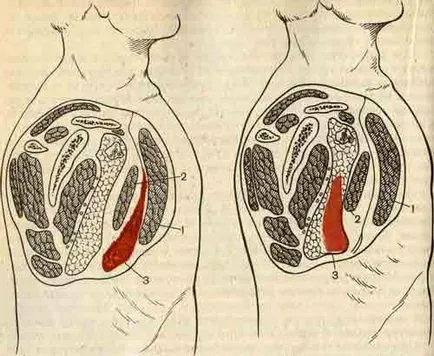 Celulită, diagnostic flemony și tratamentul celulitei în Israel