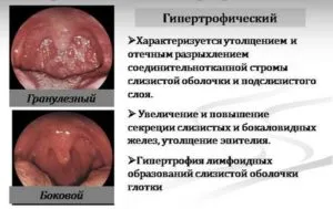 Хипертрофични фарингит симптоми, лечение (снимка)