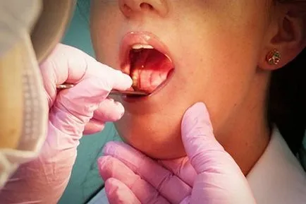 Hipertrófiás pharyngitis tünetei és kezelése