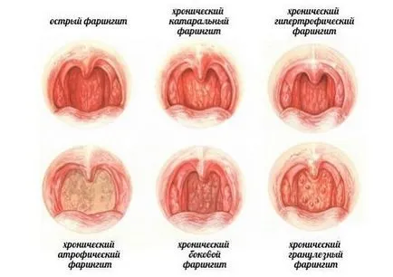 Хипертрофични фарингит симптоми и лечение