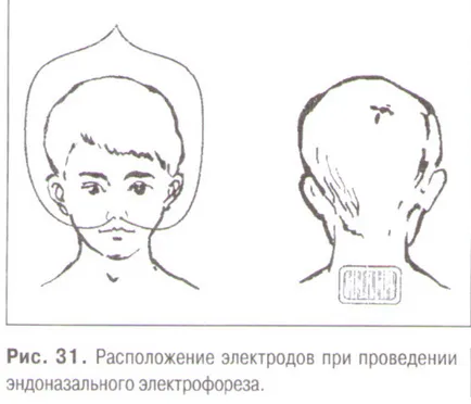 Orbito-occipital (transcerebral) Electroforeza prin Bourguignon