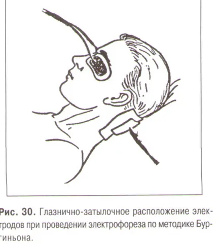 Orbito-occipitalis (transcerebral) elektroforézissel Bourguignon