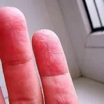 Гъбички по пръстите на симптоми, лечение и превенция