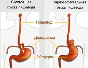 Hiatus hernia kezelésére, a tünetek, diéta ajánlások