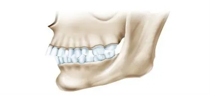 Корекция на дисталния оклузия при възрастни - техника и времето на лечение заболяване