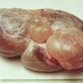 Парапельвікальная кіста лівої нирки що це таке, розміри, норми, лікування (парапельвікальная кіста лівої нирки) Парапельвікальная кіста лівої нирки що це таке, розміри, норми, лікування