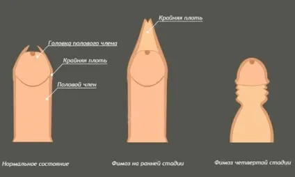 Відносний фімоз симптоми і методи лікування (відносний фімоз симптоми лікування) Відносний фімоз симптоми і методи лікування