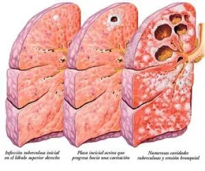 Ce medicamente accepta tuberculoza