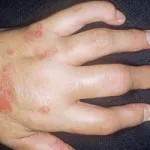 Cum de a distinge psoriazis de alergii