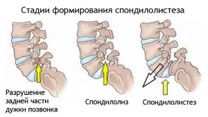 Hogyan lehet megkülönböztetni a mellkasi fájdalom neuralgia »spine❺