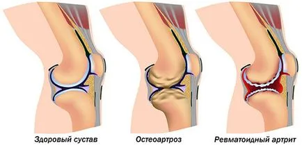 Какво лекар лекува артрит на ставите, когато се нуждаят от спешна помощ, симптомите на заболяването