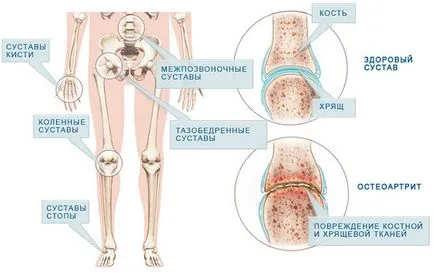 Какво лекар лекува артрит на ставите, когато се нуждаят от спешна помощ, симптомите на заболяването