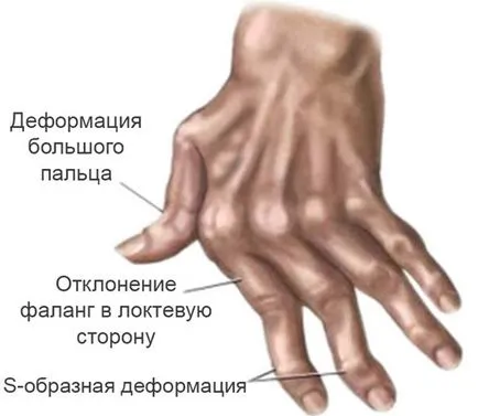 Какво лекар лекува артрит на ставите, когато се нуждаят от спешна помощ, симптомите на заболяването