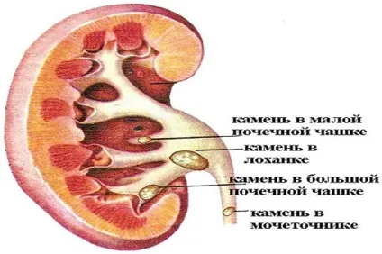 Парапельвікальная кіста нирки причини, діагностика та лікування