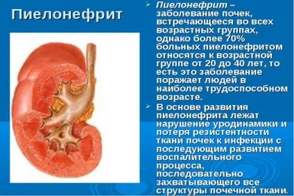 Парапельвікальная кіста нирки причини, діагностика та лікування