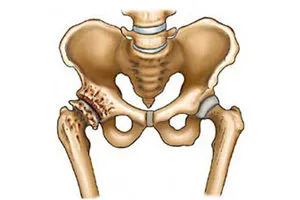 Класификация и пателофеморалната етап на артроза, neoarthrosis, femoropatellyarny, ревматоиден,