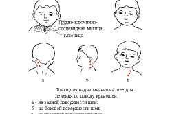 Тортиколис при деца и бебета на симптомите и лечението