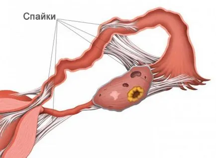 Laparotomia petefészek ciszták (törlés) mindkét halad, a hatásait