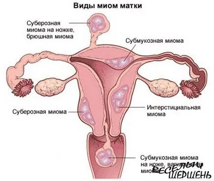 маточни фиброиди лечение на пчелите Podmore