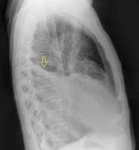 Radiodiagnosztikában hydrothorax radiográfiai és komputertomográfiás, egy második véleményt