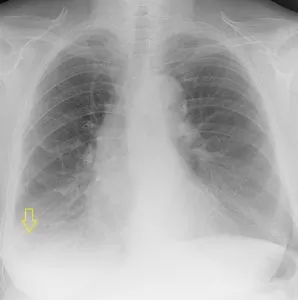 Radiodiagnosztikában hydrothorax radiográfiai és komputertomográfiás, egy második véleményt