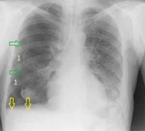 Radiodiagnosztikában hydrothorax radiográfiai és komputertomográfiás, egy második véleményt