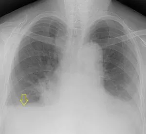 Radiodiagnosztikában hydrothorax radiográfiai és komputertomográfiás, egy második véleményt