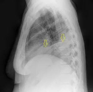 Radiodiagnosztikában hydrothorax radiográfiai és komputertomográfiás, egy második véleményt