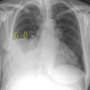 Radiodiagnosztikában hydrothorax radiográfiai és komputertomográfiás, egy második véleményt