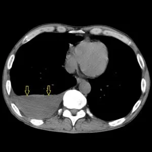 Radiodiagnosztikában hydrothorax radiográfiai és komputertomográfiás, egy második véleményt