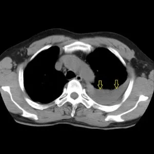 Radiodiagnosztikában hydrothorax radiográfiai és komputertomográfiás, egy második véleményt