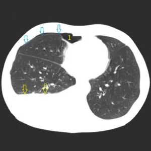 Radiodiagnostic radiografie hidrotorax si tomografie computerizata, un al doilea aviz