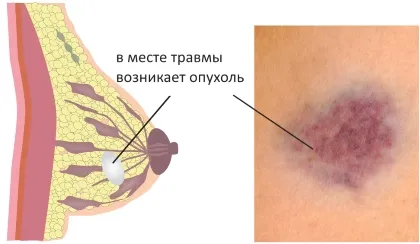 Lipogranuloma (oleogranuloma) sau necroza grăsime mamara cauze, simptome și tratament