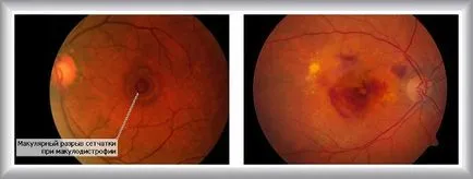 Makula degeneráció a retina - tünetek és kezelés