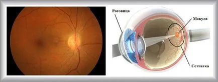 degenerare maculară a retinei - simptome și tratament
