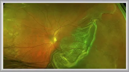 Макулна дегенерация на ретината - симптоми и лечение