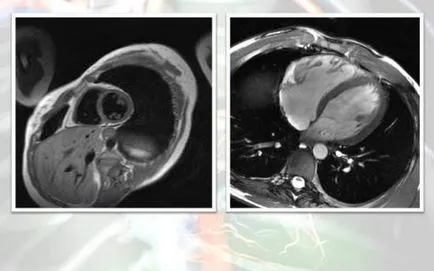 Ядрено-магнитен резонанс на сърцето и коронарните съдове, който показва