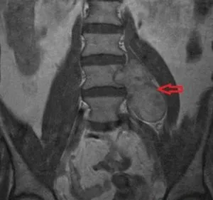 Neuroma gerinc tünetek, okok és kezelés