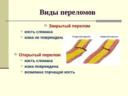 törött láb (beltéri és kültéri) jelek, hogyan kell járni a gipsz