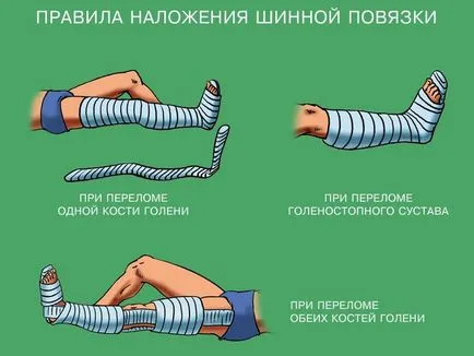 счупен крак (открит и закрит) знаци, как да ходят в гипсова отливка