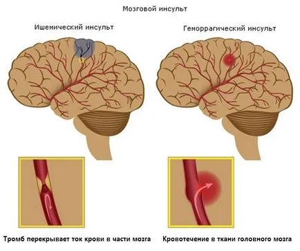 Az első jelei a stroke tüneteinek és az első támogatási szabályok