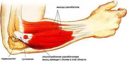 De ce musculare cot inflamat cauze, diagnostic