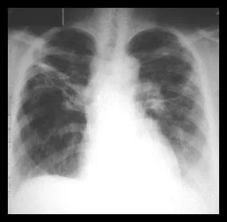 Înfrângerea parenchimului pulmonar