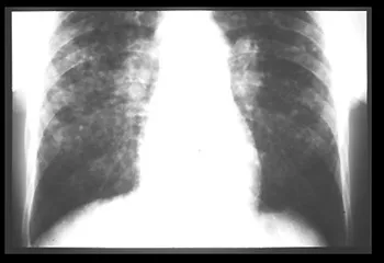 Înfrângerea parenchimului pulmonar