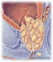 Preparate pentru tratamentul caracteristici prostatita și nuanțe