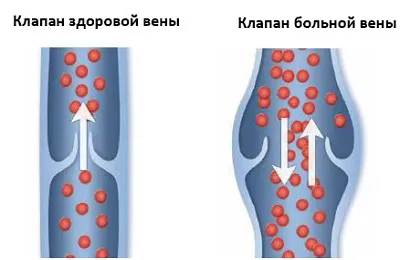 Причините за разширени вени от това, което изглежда и Психосоматиката разширени вени