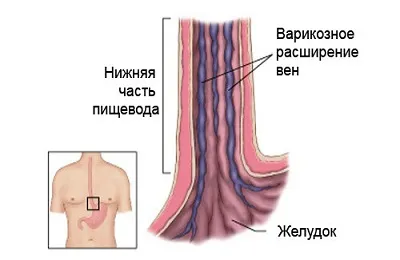 Причините за разширени вени от това, което изглежда и Психосоматиката разширени вени