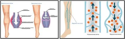 Причините за разширени вени от това, което изглежда и Психосоматиката разширени вени