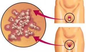 Antiherpethetical immunglobulin-kezelés és az adagolás