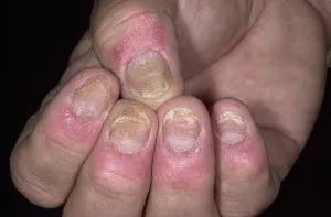 Psoriatica arthropathia, psoriasis kezelésére